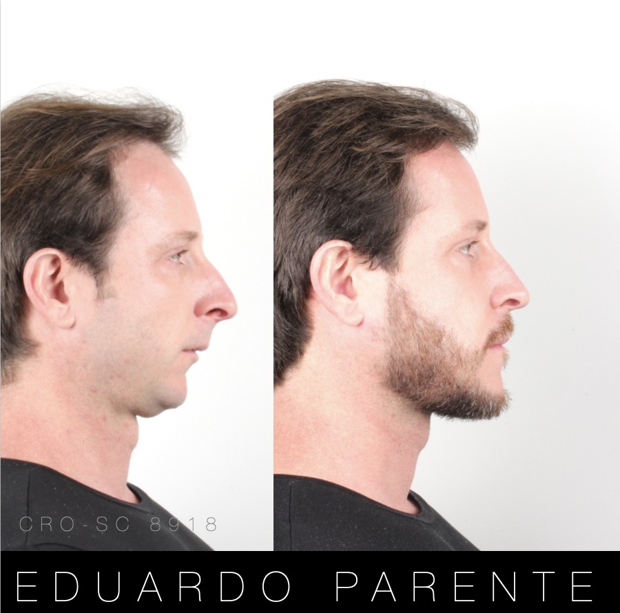 Antes e depois — Classe II: perfil facial antes (à esquerda) e depois (à direita) da cirurgia ortognática