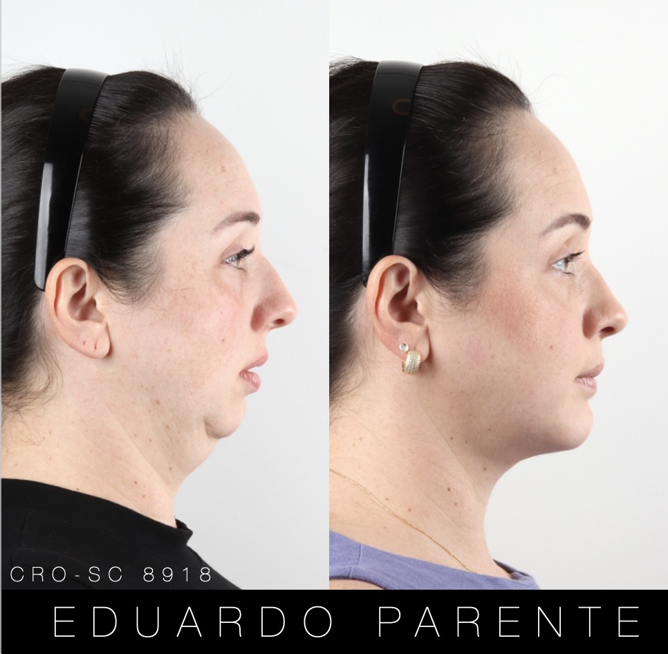 Antes e depois — Classe II: perfil facial antes (à esquerda) e depois (à direita) da cirurgia ortognática