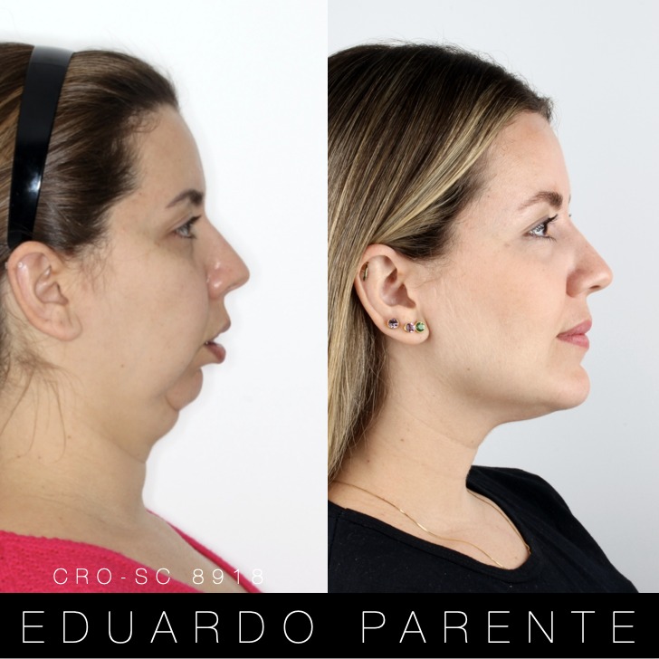 Antes e depois — Classe II: perfil facial antes (à esquerda) e depois (à direita) da cirurgia ortognática
