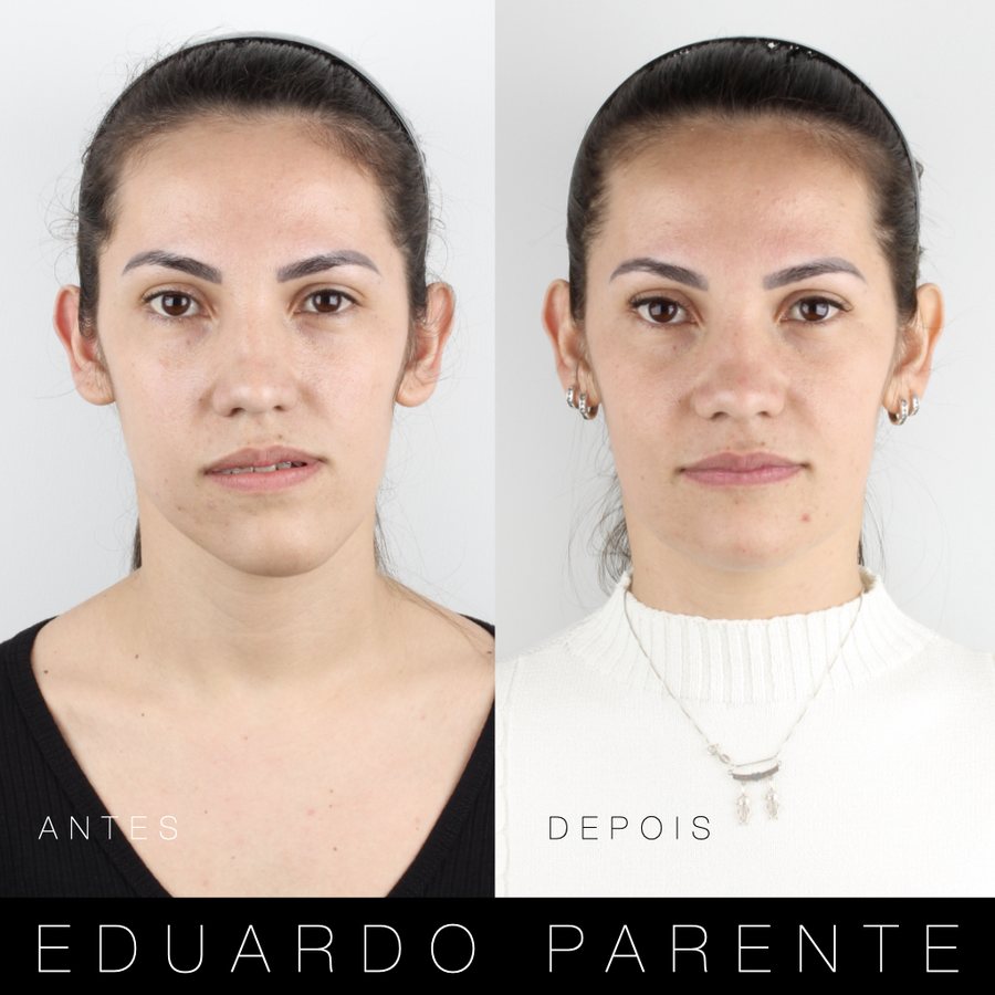 Antes e depois — Assimetria facial: face de frente antes (à esquerda) e depois (à direita) da cirurgia ortognática