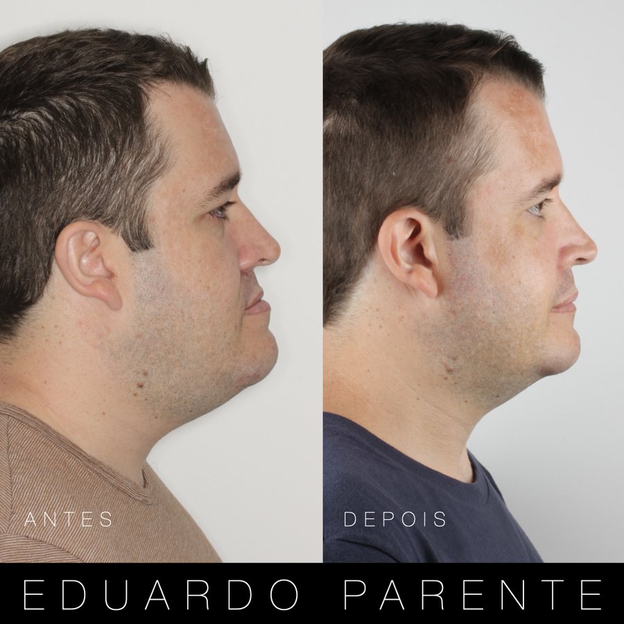 Antes e depois — Classe III: perfil facial antes (à esquerda) e depois (à direita) da cirurgia ortognática