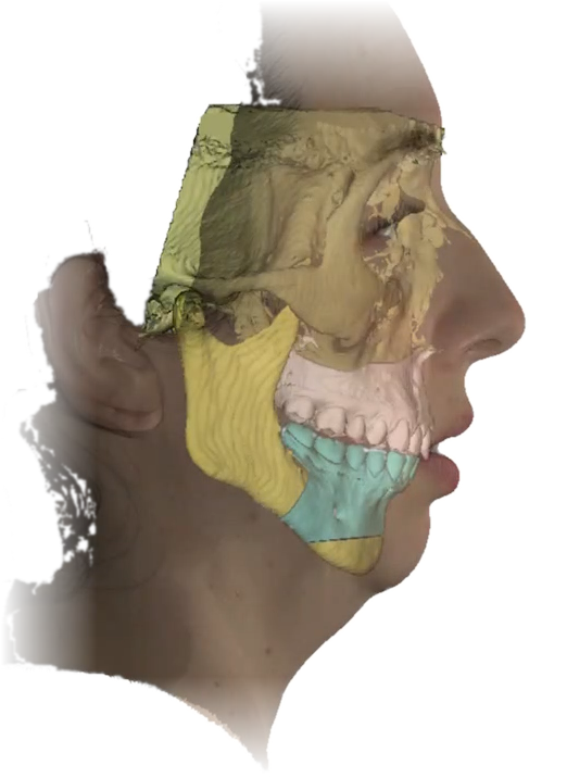 Perfil da paciente na tomografia antes da cirurgia: maxila em amarelo e mandíbula em azul, com o queixo recuado